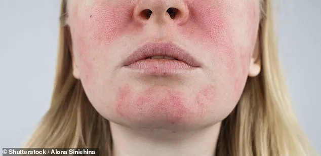 From Acne to Rosacea: Janet Atkins' Unending Battle with Chronic Skin Conditions