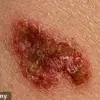 Influencer's Near-Fatal Skin Cancer Experience Highlights Risks of Dismissing Early Symptoms and Urges Public Health Awareness