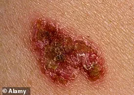 Influencer's Near-Fatal Skin Cancer Experience Highlights Risks of Dismissing Early Symptoms and Urges Public Health Awareness