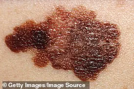 Influencer's Near-Fatal Skin Cancer Experience Highlights Risks of Dismissing Early Symptoms and Urges Public Health Awareness