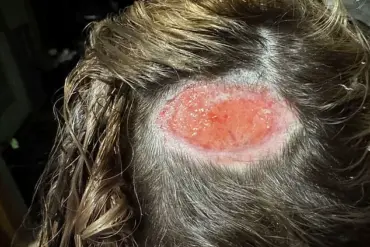 North Carolina Teen Suffers Severe Scalp Injury After Hair Dye Mishap at Salon
