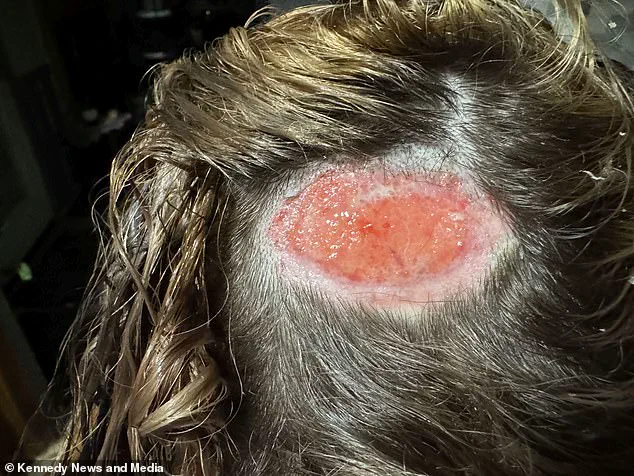 North Carolina Teen Suffers Severe Scalp Injury After Hair Dye Mishap at Salon