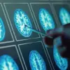 Post-pandemic Surge in Gut-Brain Disorders: 28% Rise in IBS Cases Revealed in UK-US Study (2017-2023)