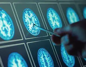 Post-pandemic Surge in Gut-Brain Disorders: 28% Rise in IBS Cases Revealed in UK-US Study (2017-2023)