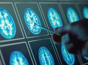 Post-pandemic Surge in Gut-Brain Disorders: 28% Rise in IBS Cases Revealed in UK-US Study (2017-2023)