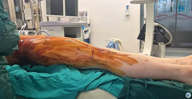 Surge in UK Men Paying Abroad for Painful Height-Boosting Surgery as Demand for 'Leg Lengthening' Procedures Soars