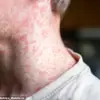 Urgent Call to Vaccinate Children Amid Measles Surge: Health Chiefs Warn Summer Travel Risks Could Exacerbate Crisis
