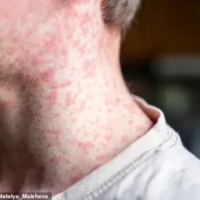 Urgent Call to Vaccinate Children Amid Measles Surge: Health Chiefs Warn Summer Travel Risks Could Exacerbate Crisis