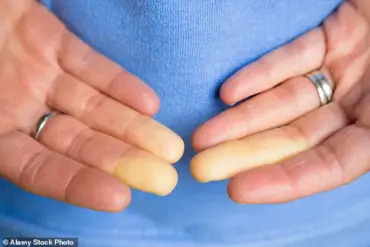 Regulatory Advances May Bring Relief for Raynaud's Patients