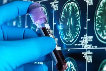 UCL Trial: Cheap Blood Tests May Revolutionize Alzheimer's Detection in NHS