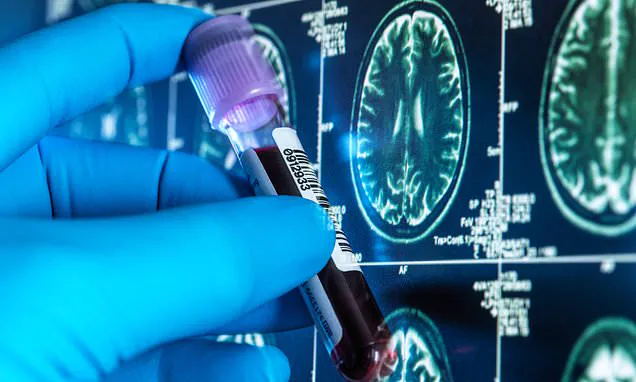 UCL Trial: Cheap Blood Tests May Revolutionize Alzheimer's Detection in NHS
